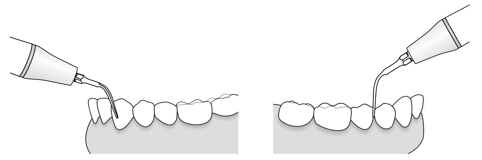 Сфера применения наконечника для скалера